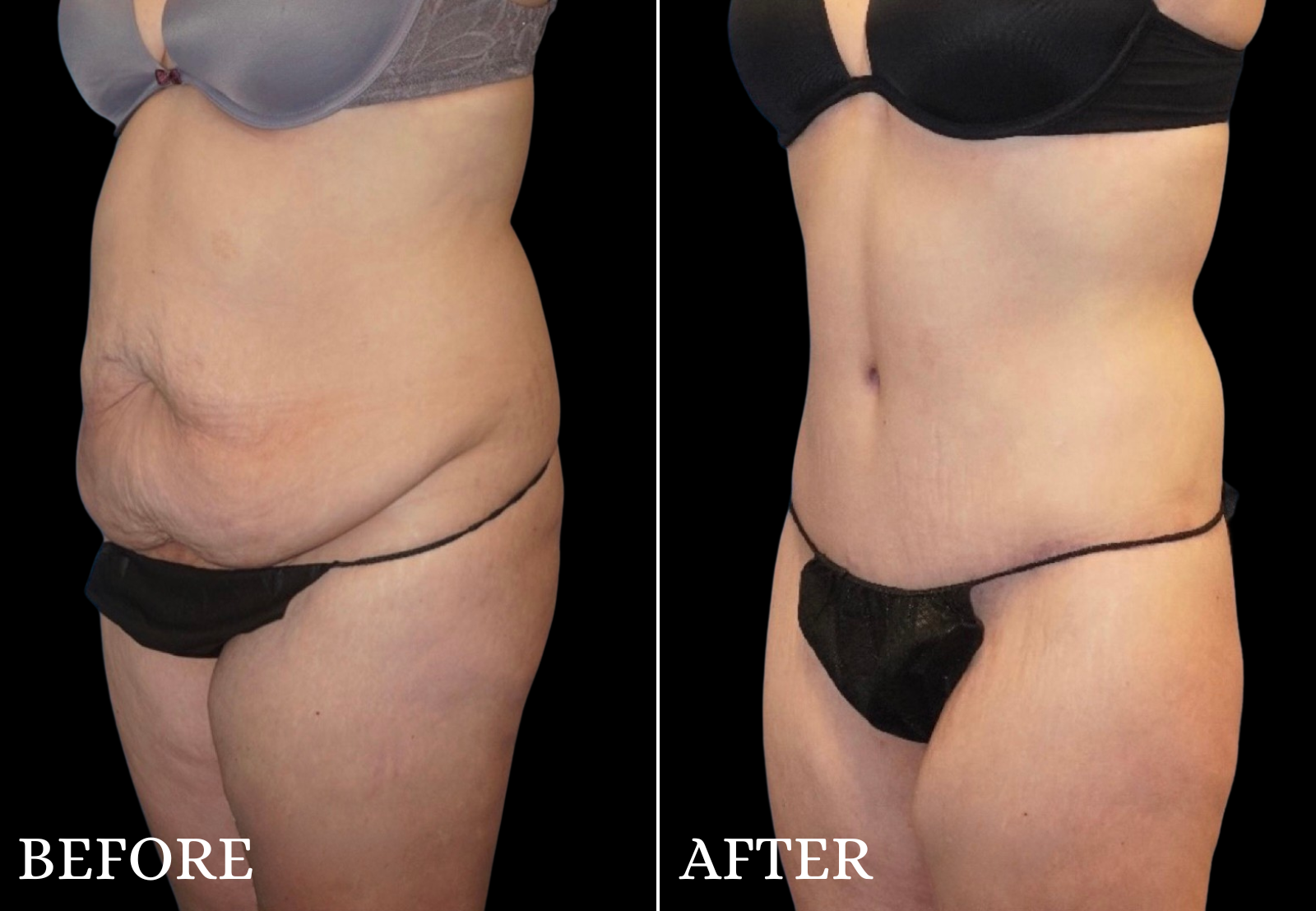 Tummy Tuck Before & After Gallery - Patient 229703 - Image 3