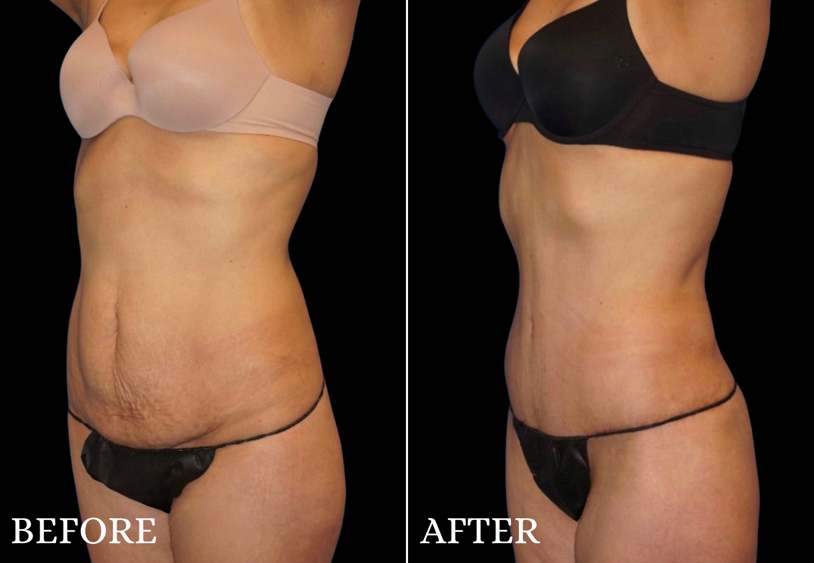 Tummy Tuck Before & After Gallery - Patient 354598 - Image 4