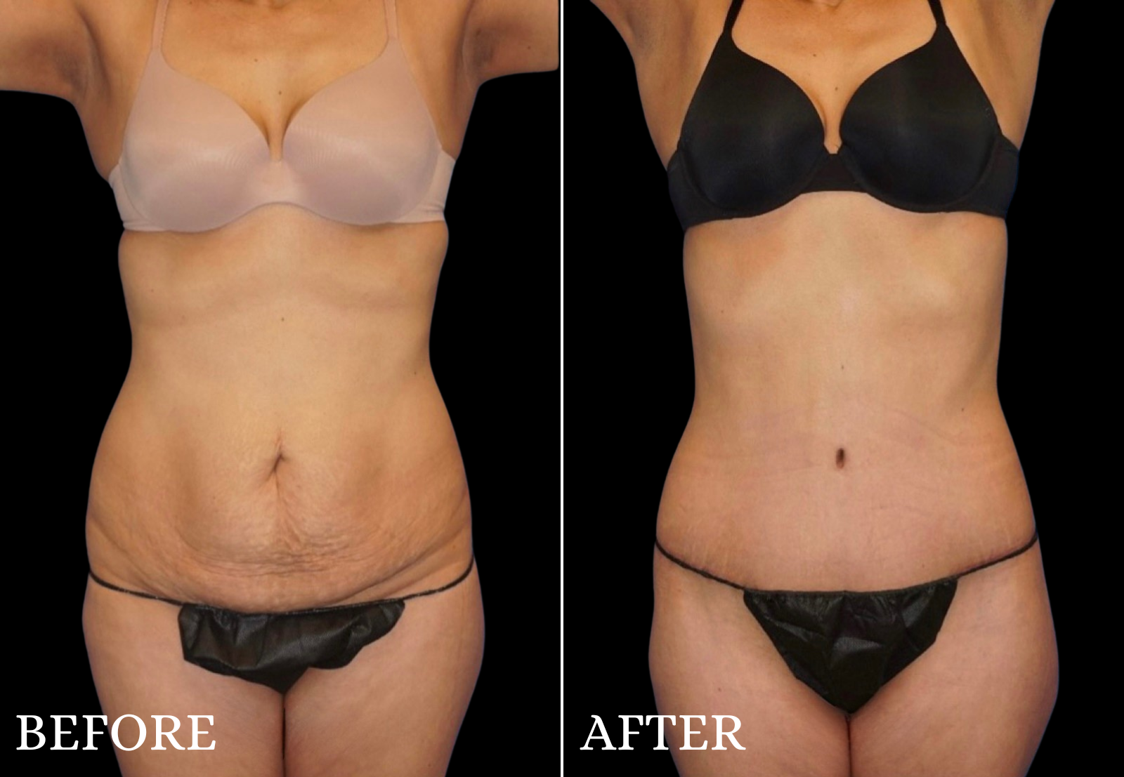 Tummy Tuck Before & After Gallery - Patient 354598 - Image 1