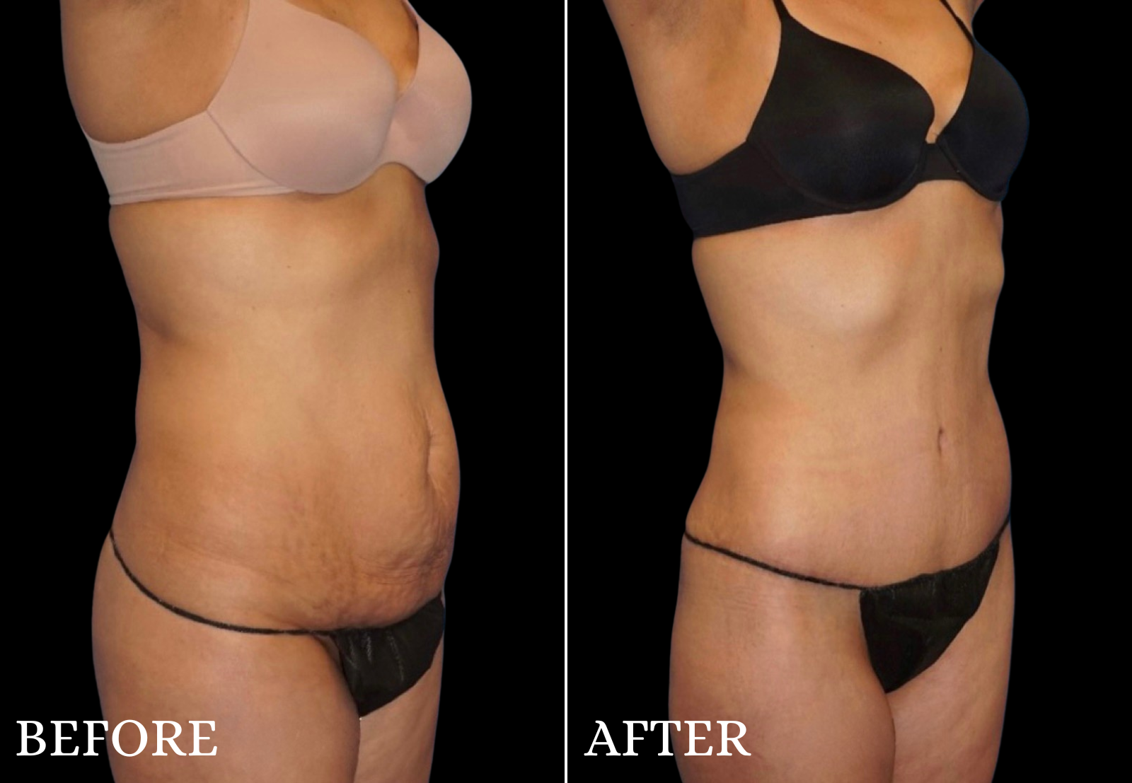 Tummy Tuck Before & After Gallery - Patient 354598 - Image 2