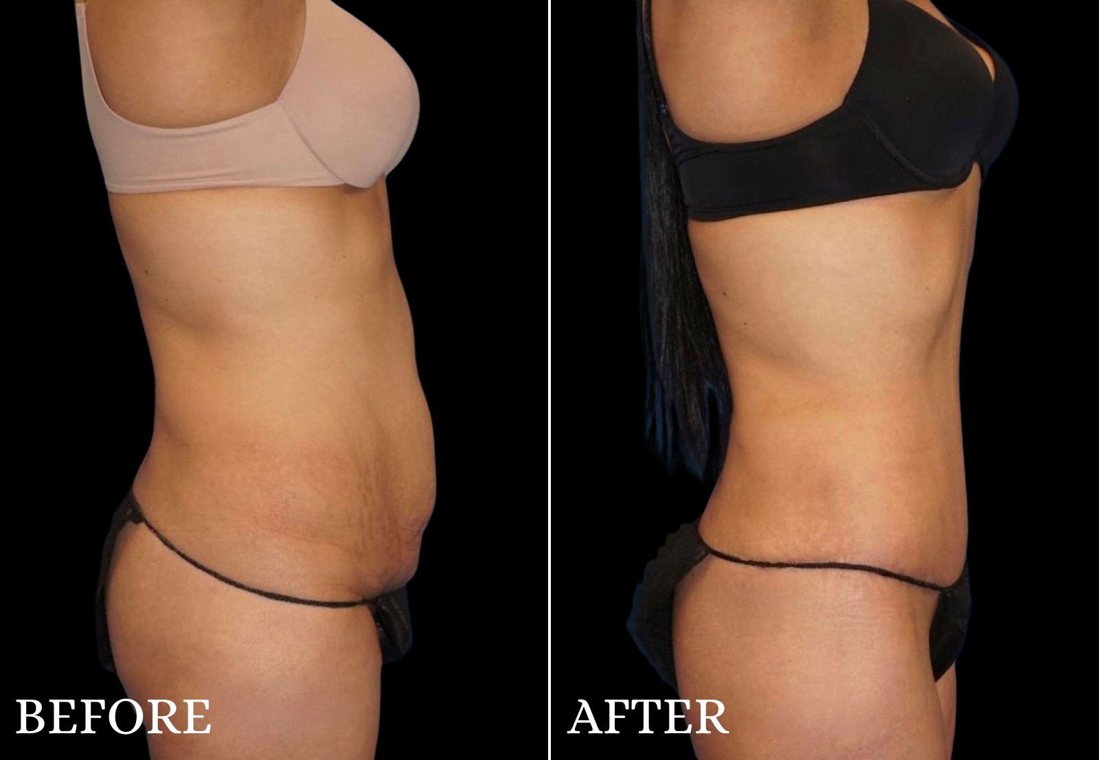Tummy Tuck Before & After Gallery - Patient 354598 - Image 3