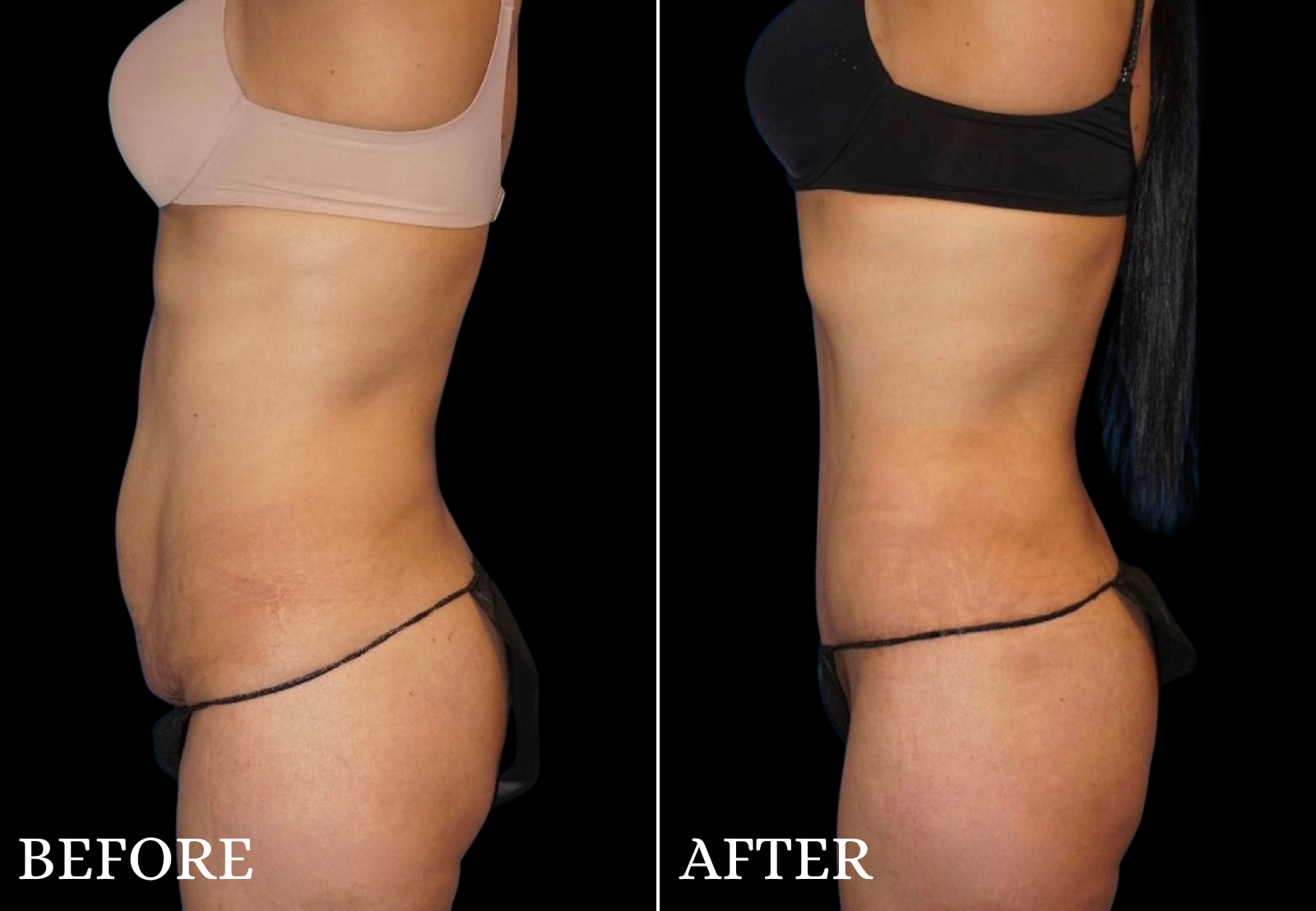 Tummy Tuck Before & After Gallery - Patient 354598 - Image 5