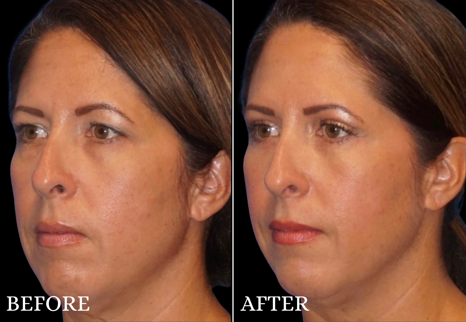 Upper Blepharoplasty Before & After Gallery - Patient 386603 - Image 4