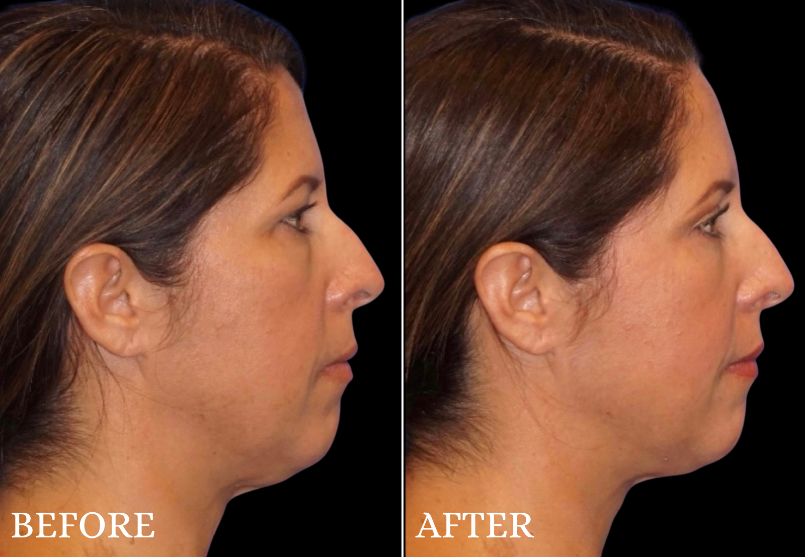 Upper Blepharoplasty Before & After Gallery - Patient 386603 - Image 3