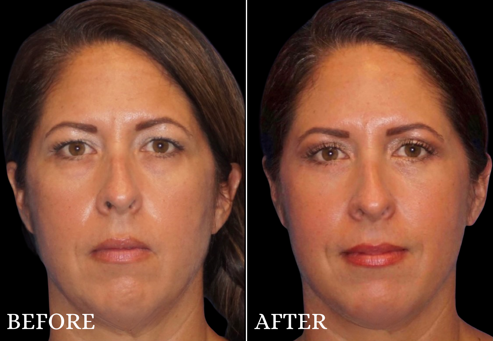 Upper Blepharoplasty Before & After Gallery - Patient 386603 - Image 1