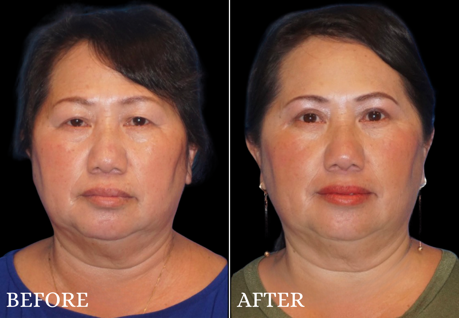 Upper Blepharoplasty Before & After Gallery - Patient 237728 - Image 1