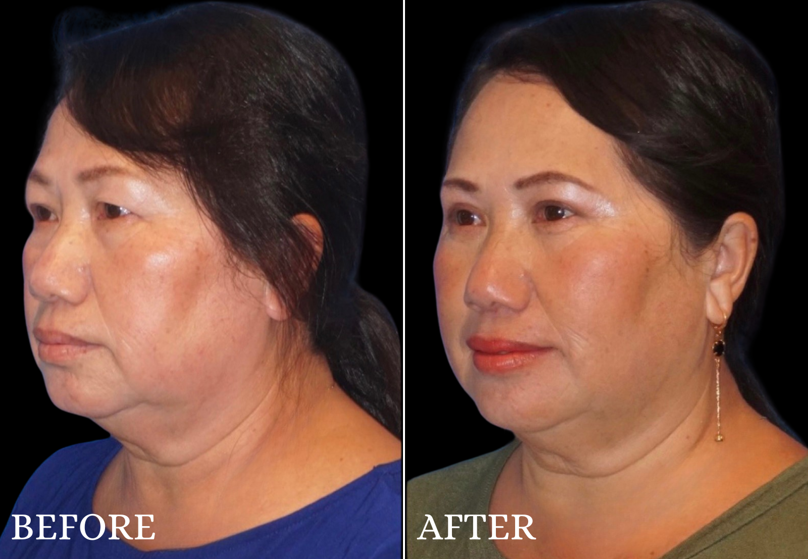 Upper Blepharoplasty Before & After Gallery - Patient 237728 - Image 4