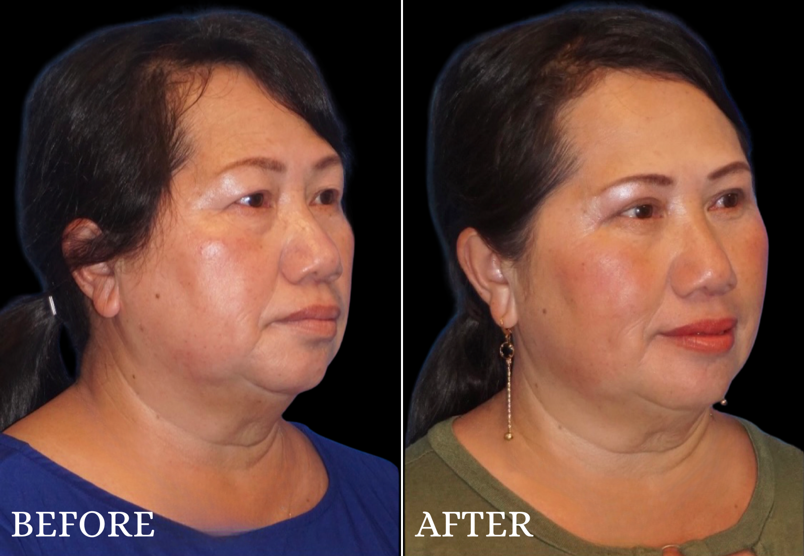 Upper Blepharoplasty Before & After Gallery - Patient 237728 - Image 2