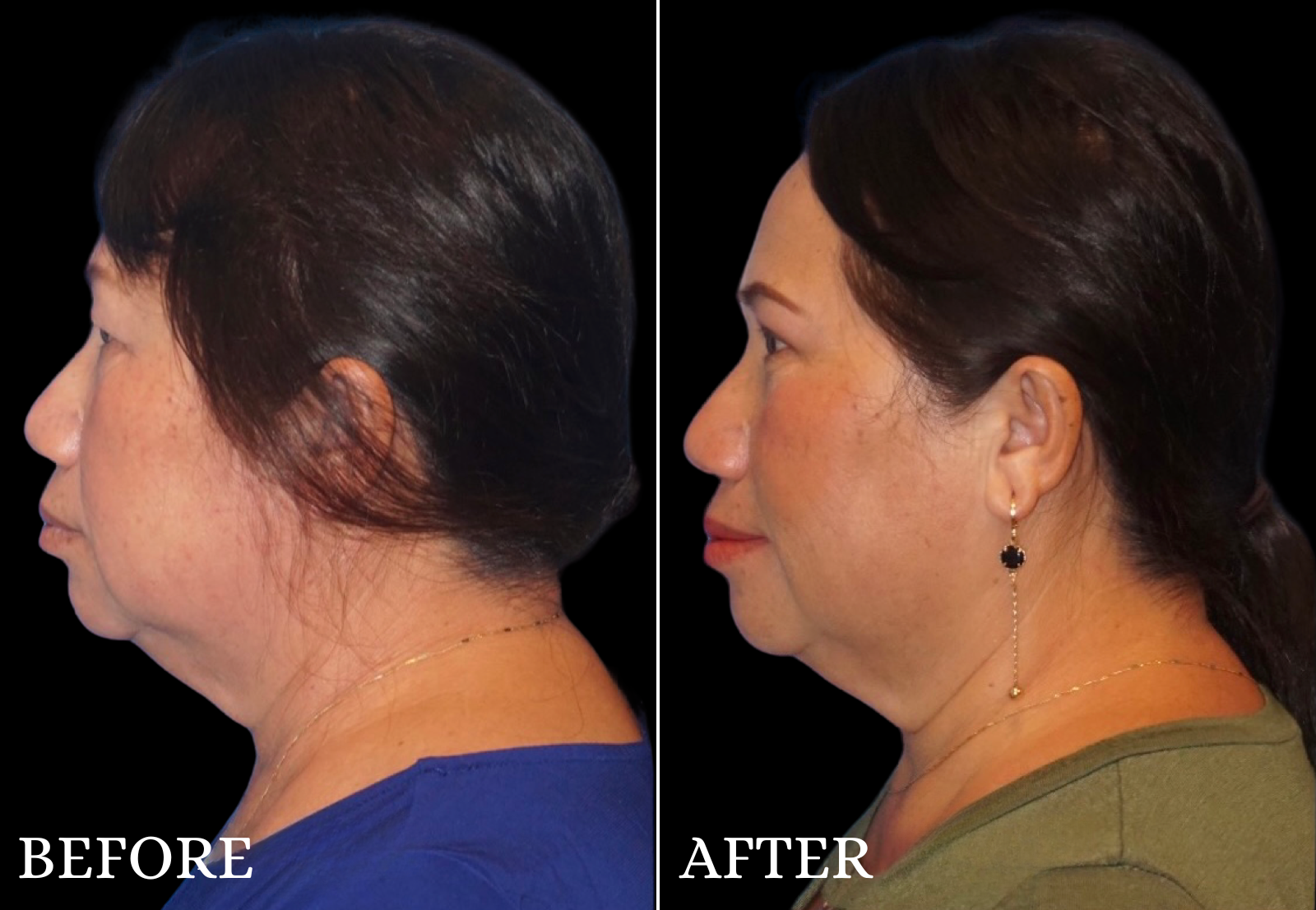 Upper Blepharoplasty Before & After Gallery - Patient 237728 - Image 5