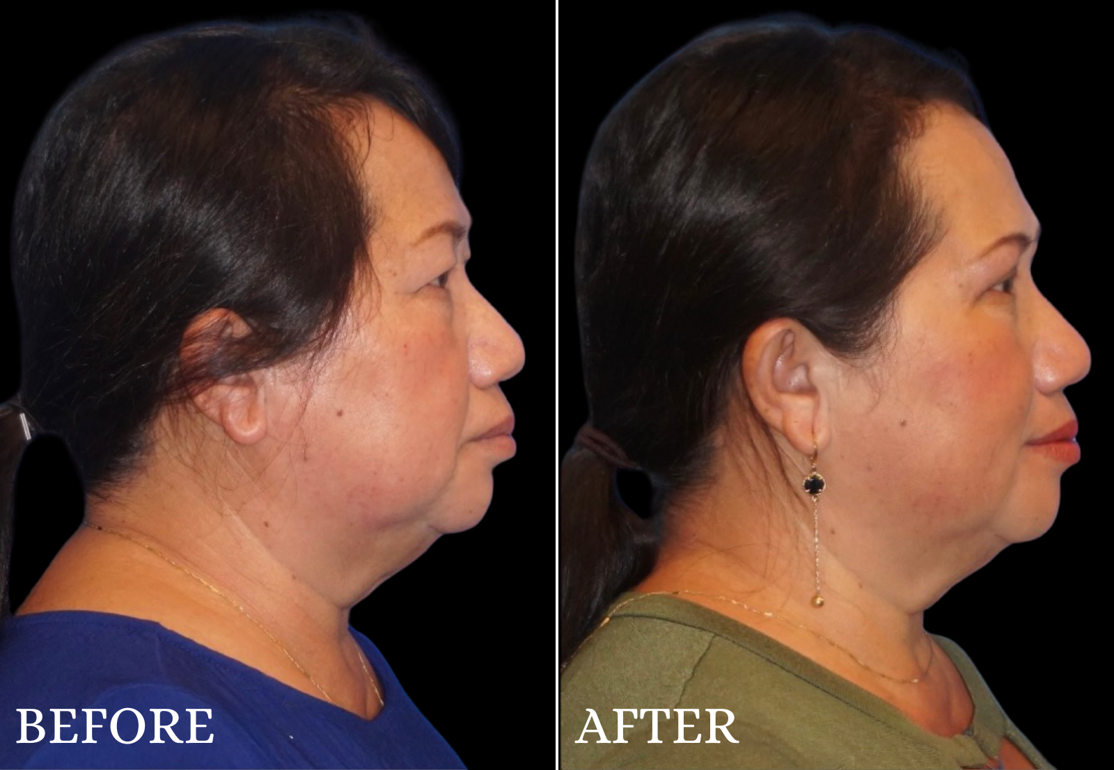 Upper Blepharoplasty Before & After Gallery - Patient 237728 - Image 3