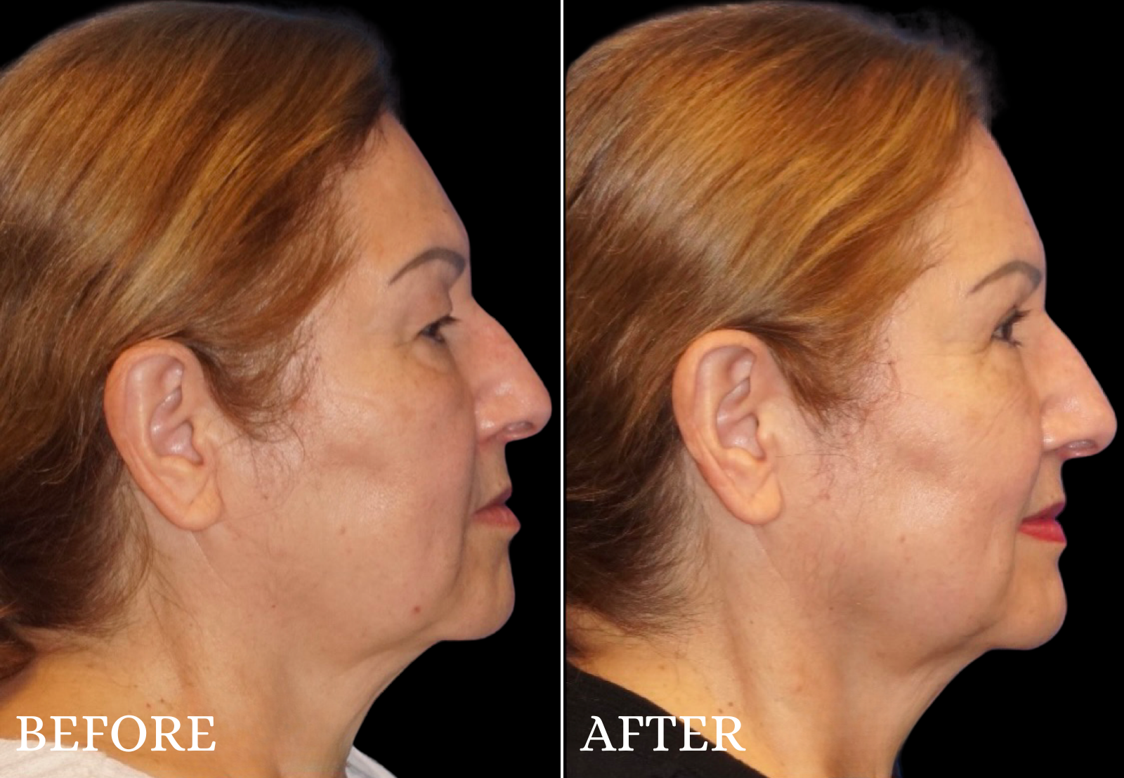 Upper Blepharoplasty Before & After Gallery - Patient 196793 - Image 3
