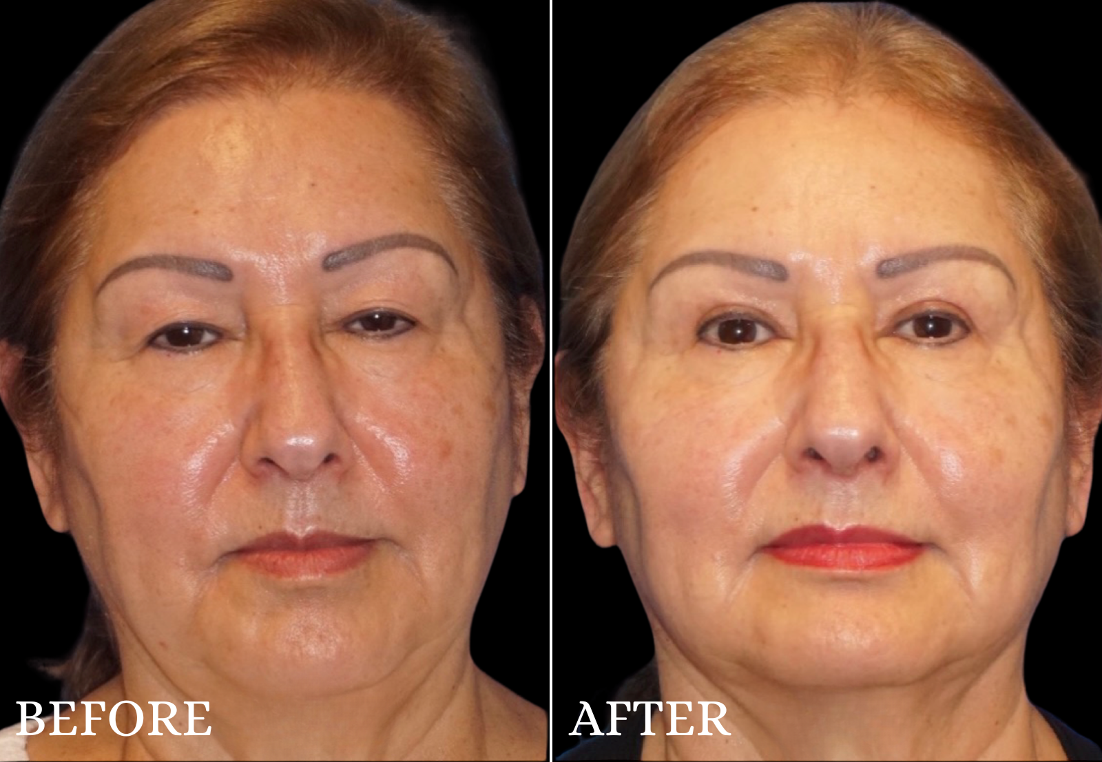 Upper Blepharoplasty Before & After Gallery - Patient 196793 - Image 1