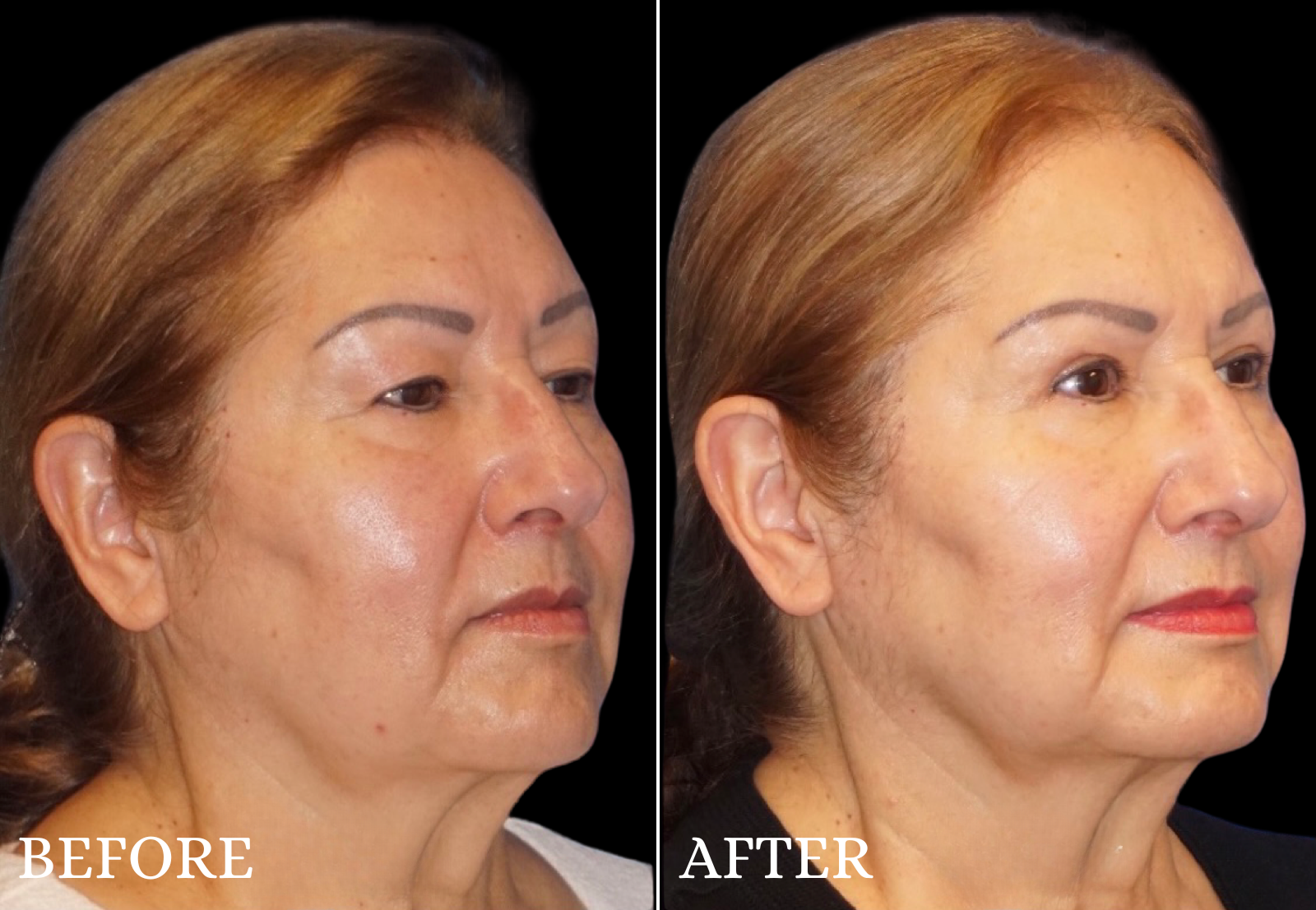 Upper Blepharoplasty Before & After Gallery - Patient 196793 - Image 2