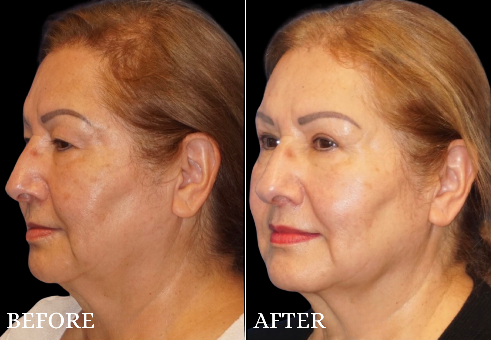 Upper Blepharoplasty Before & After Gallery - Patient 196793 - Image 4