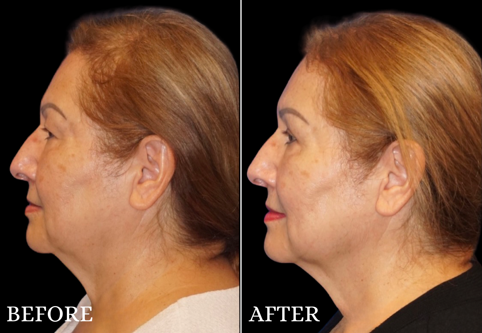 Upper Blepharoplasty Before & After Gallery - Patient 196793 - Image 5