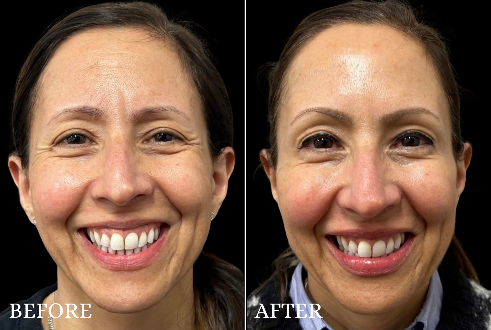 BOTOX/Dysport Before & After Gallery - Patient 279453 - Image 1