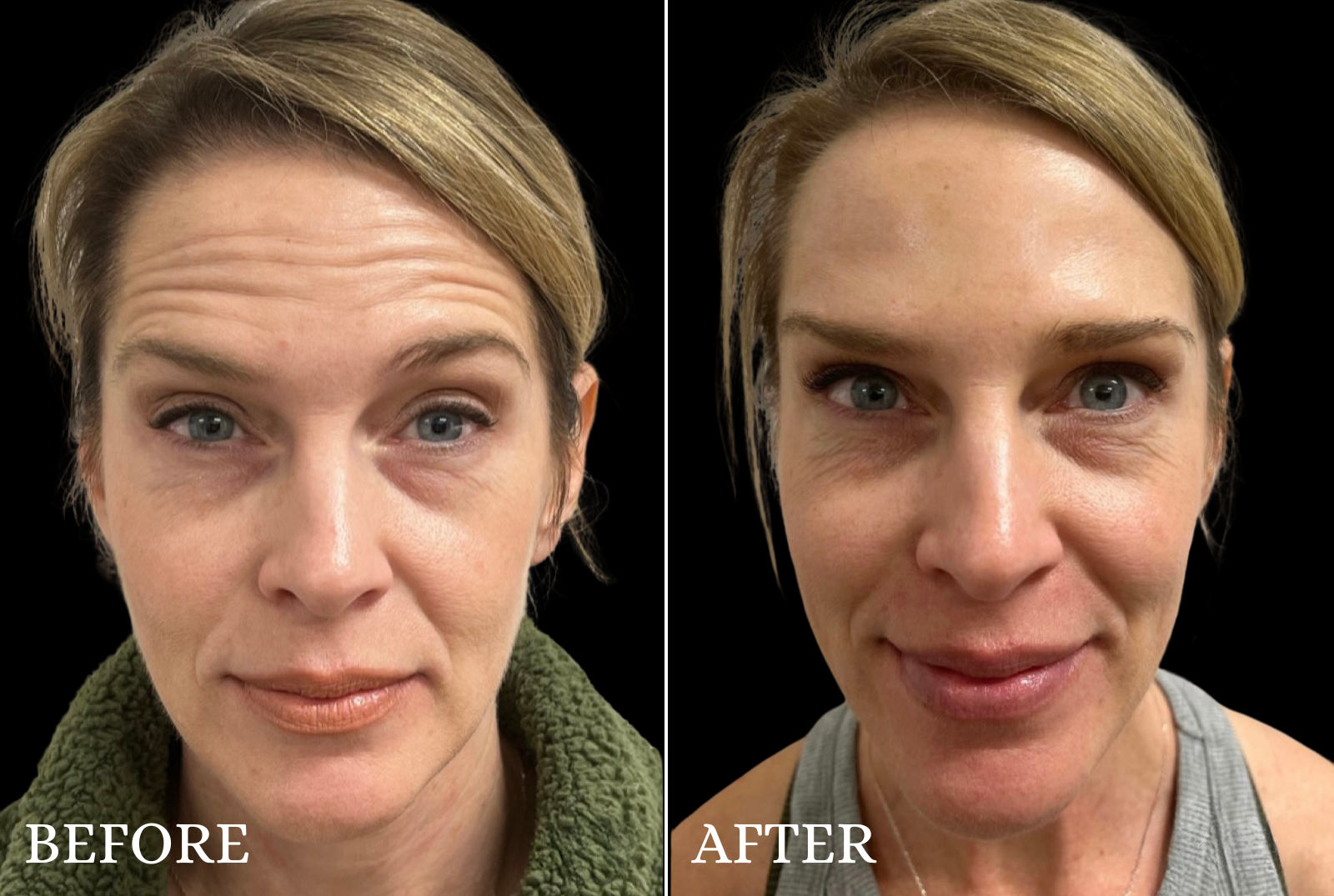 BOTOX/Dysport Before & After Gallery - Patient 458161 - Image 1