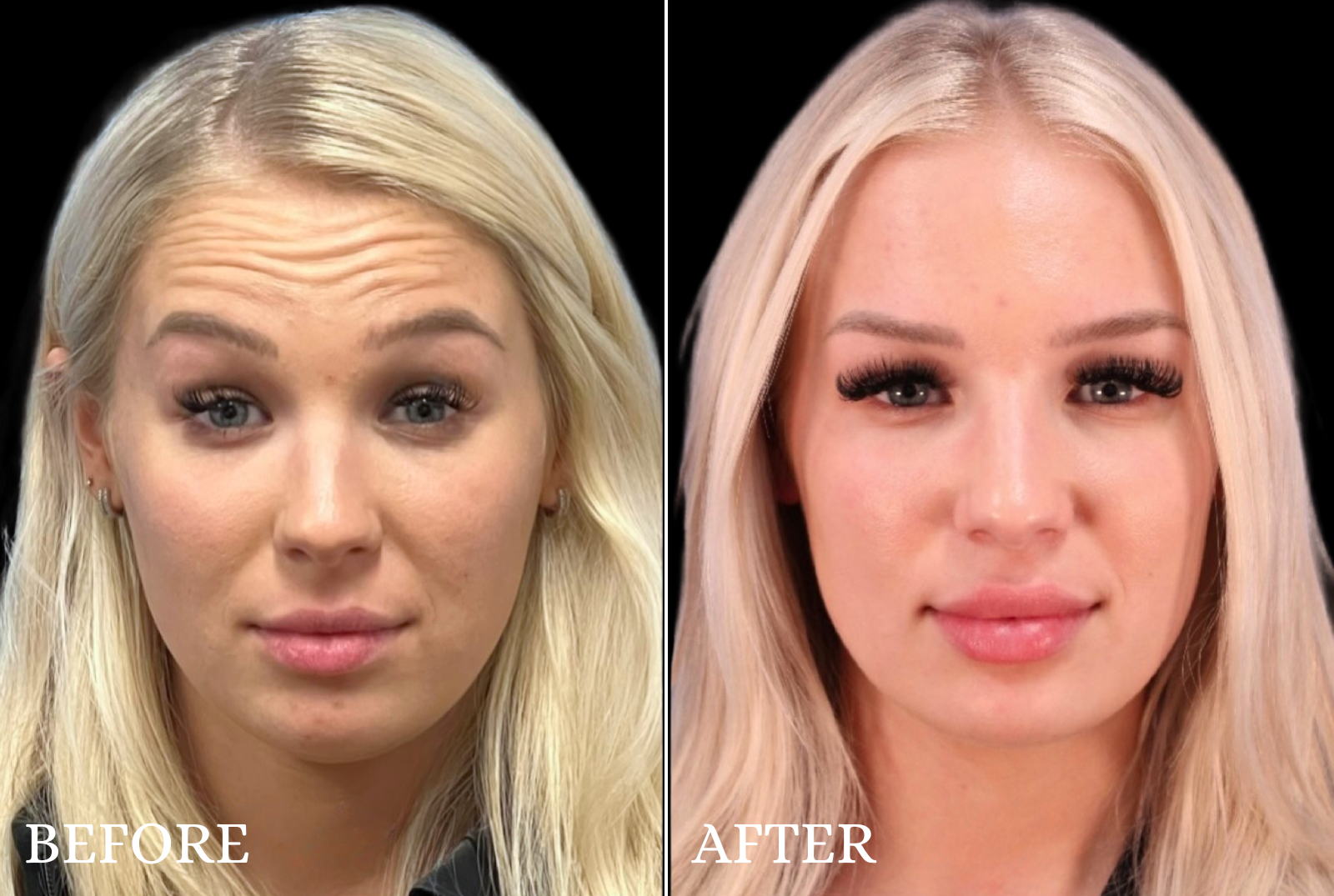 BOTOX/Dysport Before & After Gallery - Patient 182018 - Image 1