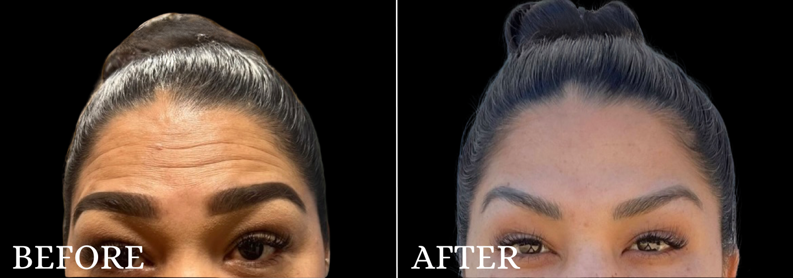 BOTOX/Dysport Before & After Gallery - Patient 387889 - Image 1