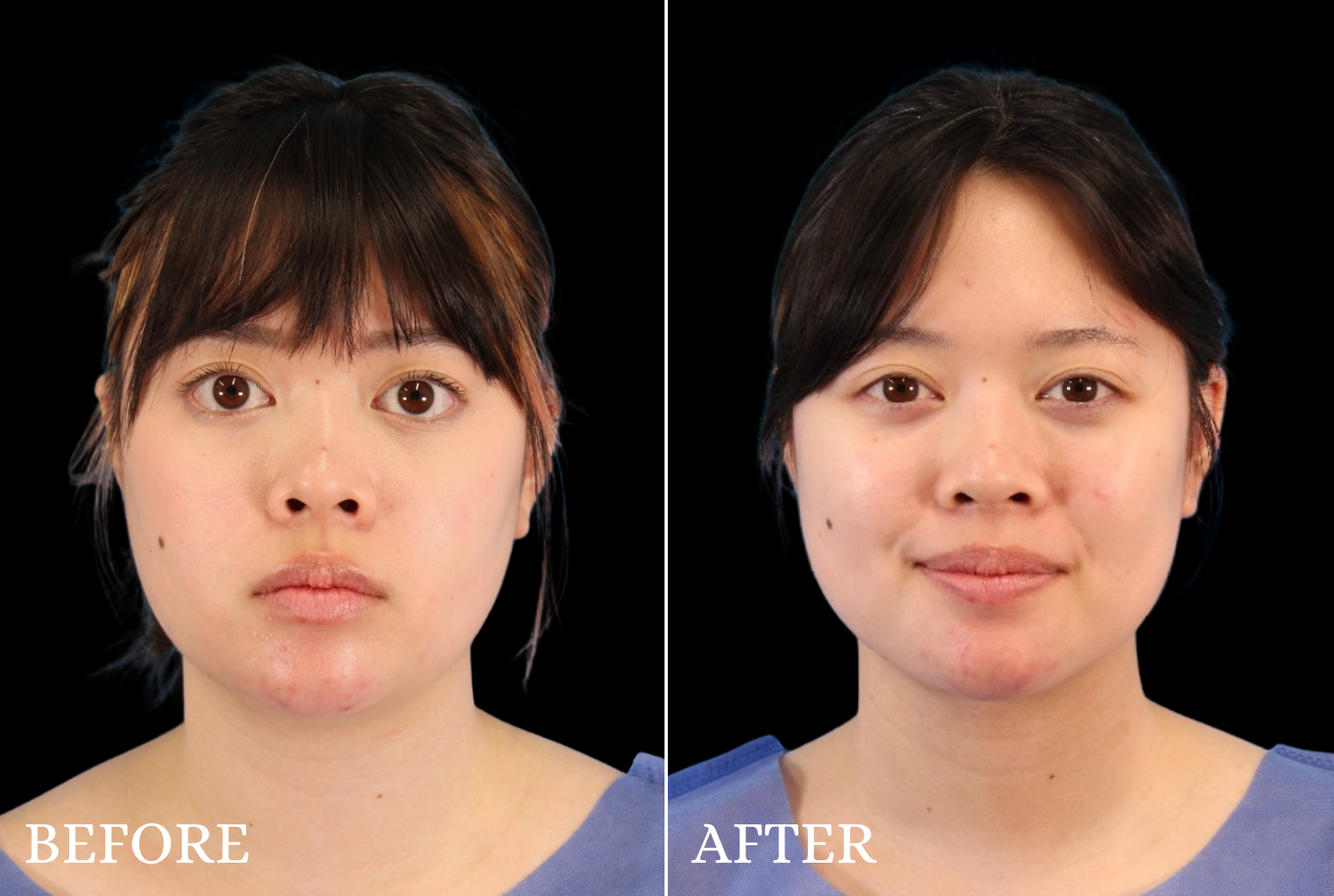 Chin Liposuction Before & After Gallery - Patient 140611 - Image 3