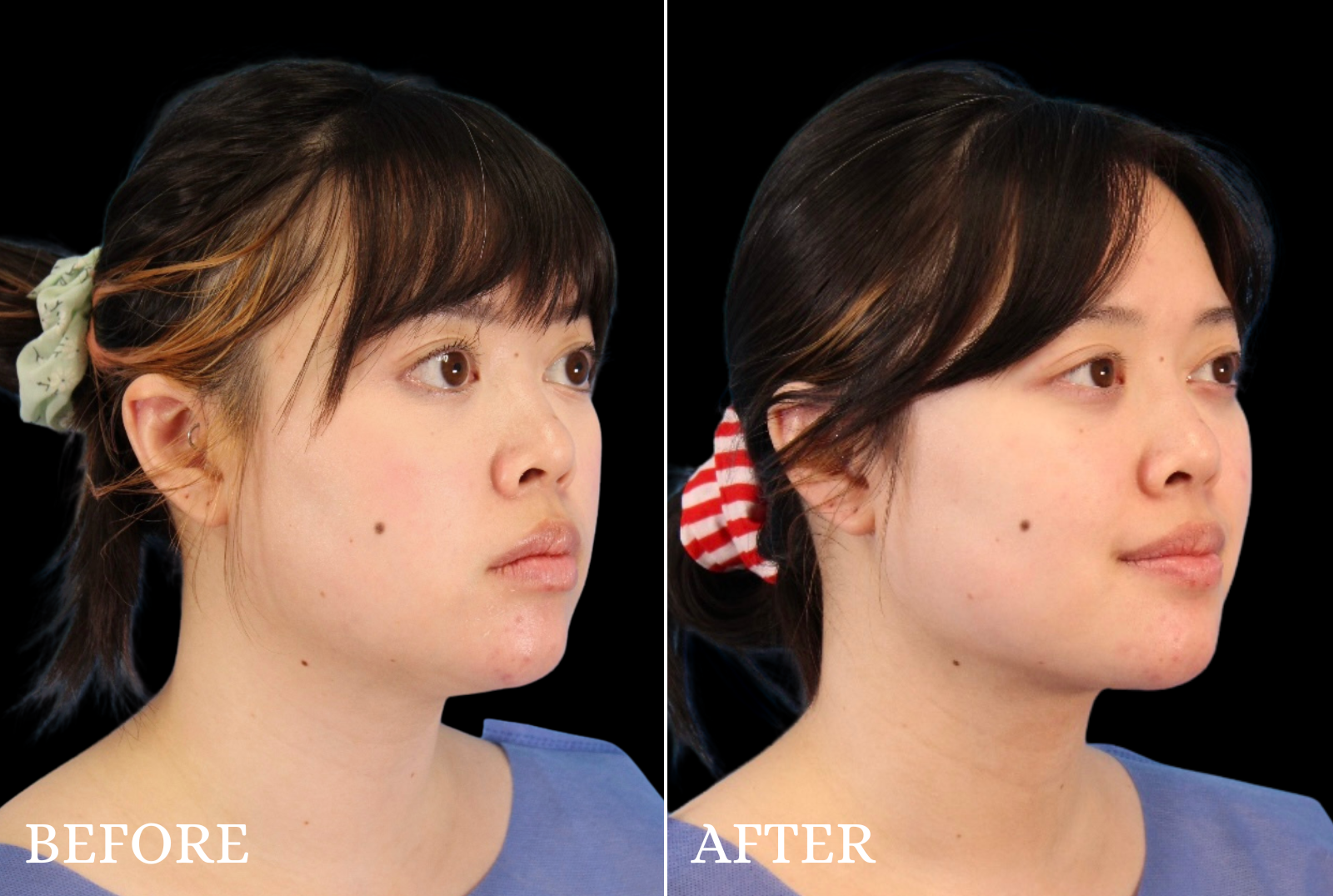 Chin Liposuction Before & After Gallery - Patient 140611 - Image 2