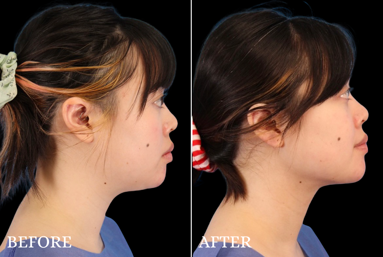 Chin Liposuction Before & After Gallery - Patient 140611 - Image 1