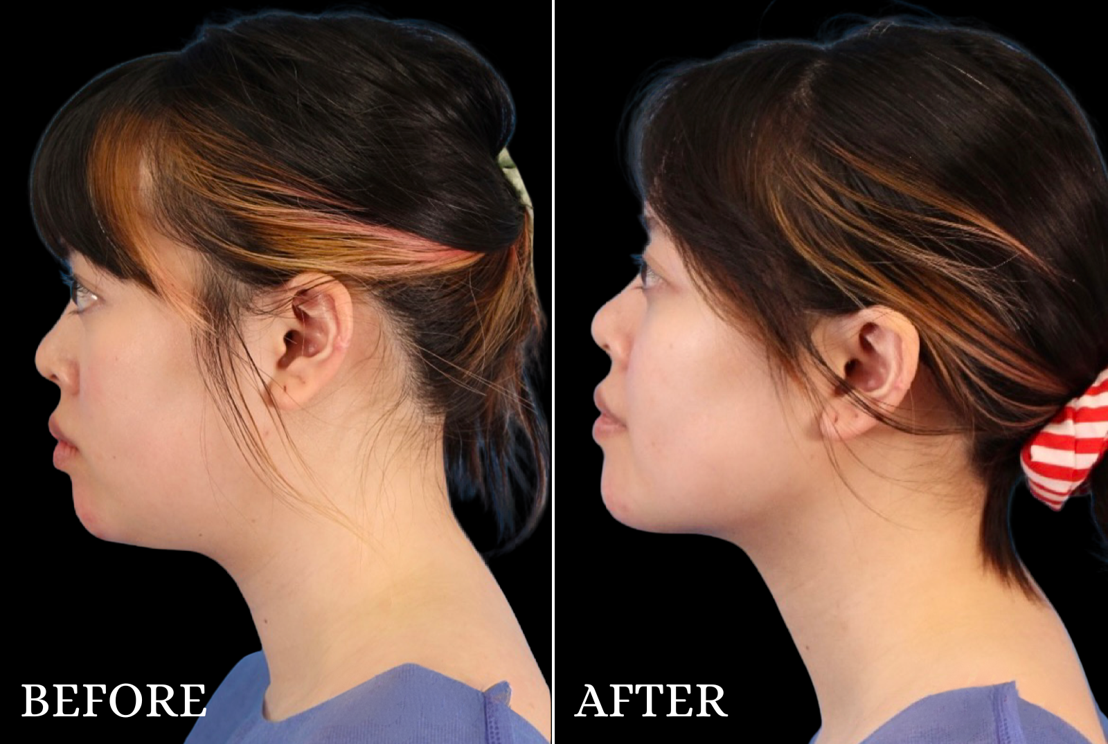 Chin Liposuction Before & After Gallery - Patient 140611 - Image 5
