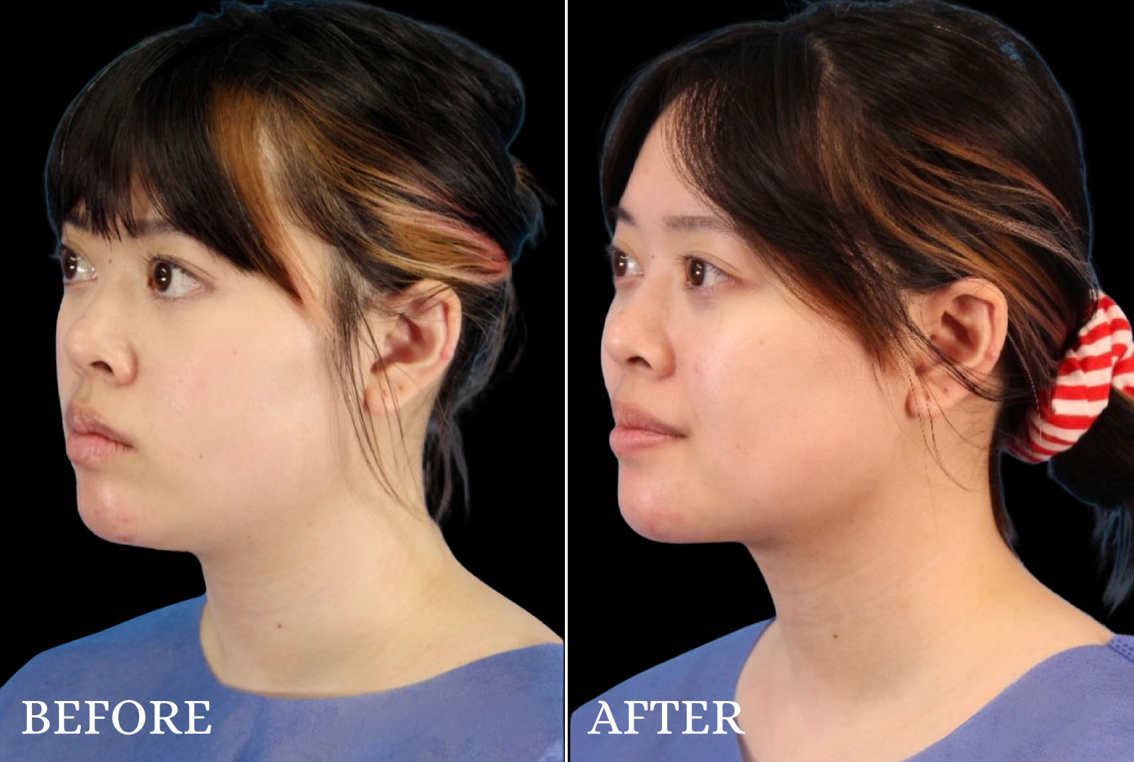 Chin Liposuction Before & After Gallery - Patient 140611 - Image 4