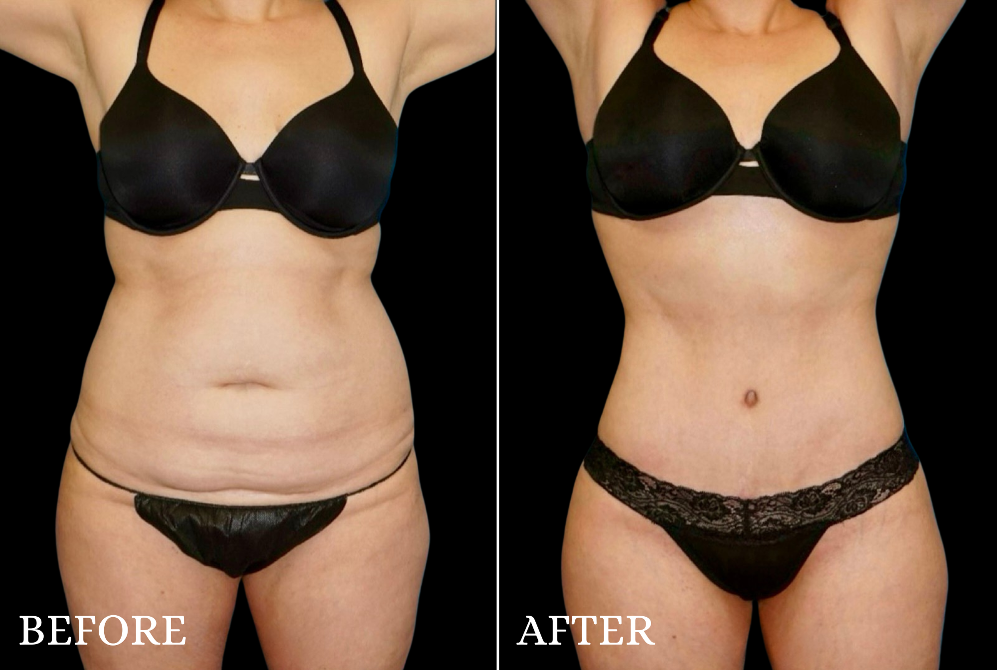 Tummy Tuck Before & After Gallery - Patient 132664 - Image 1