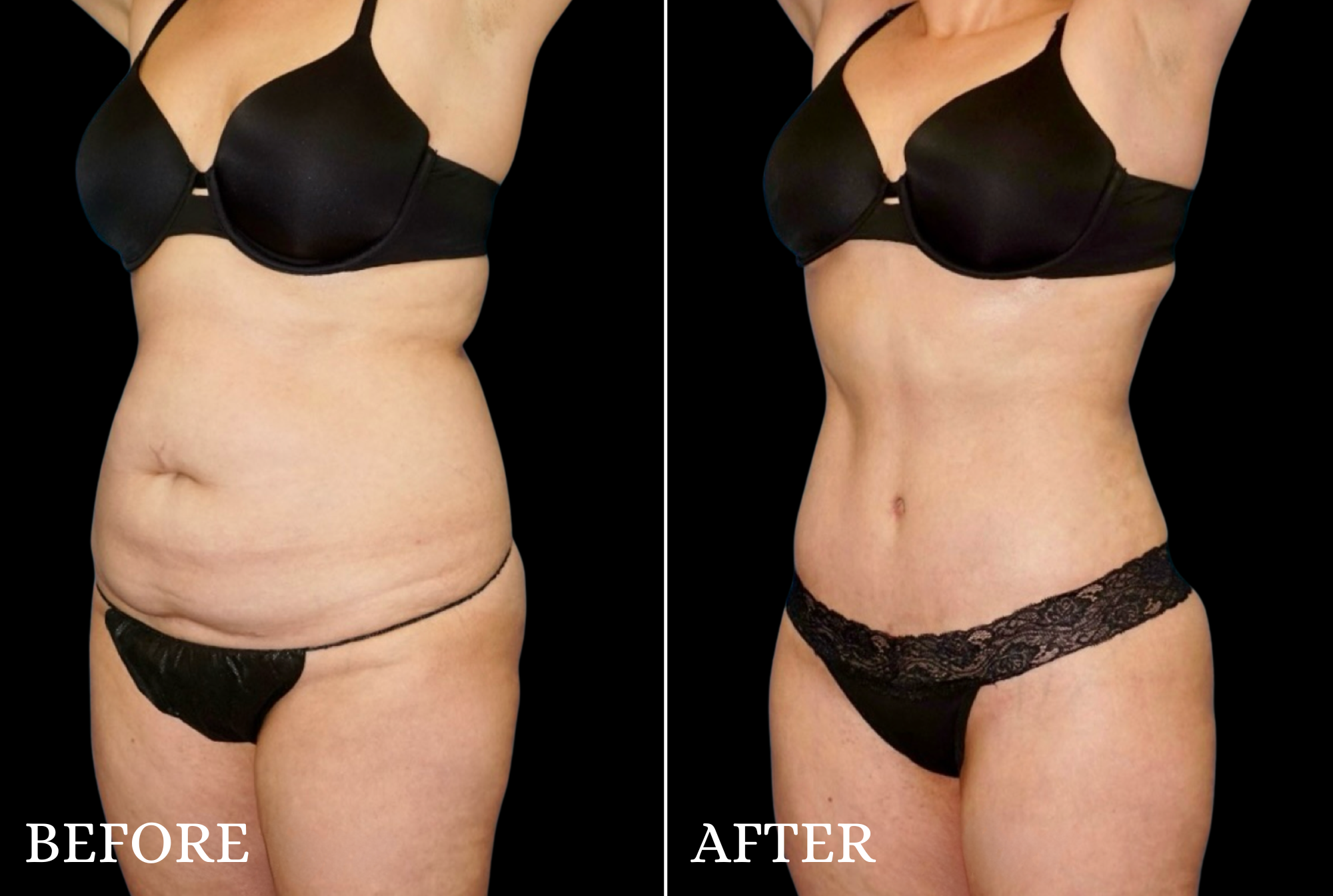 Tummy Tuck Before & After Gallery - Patient 132664 - Image 4