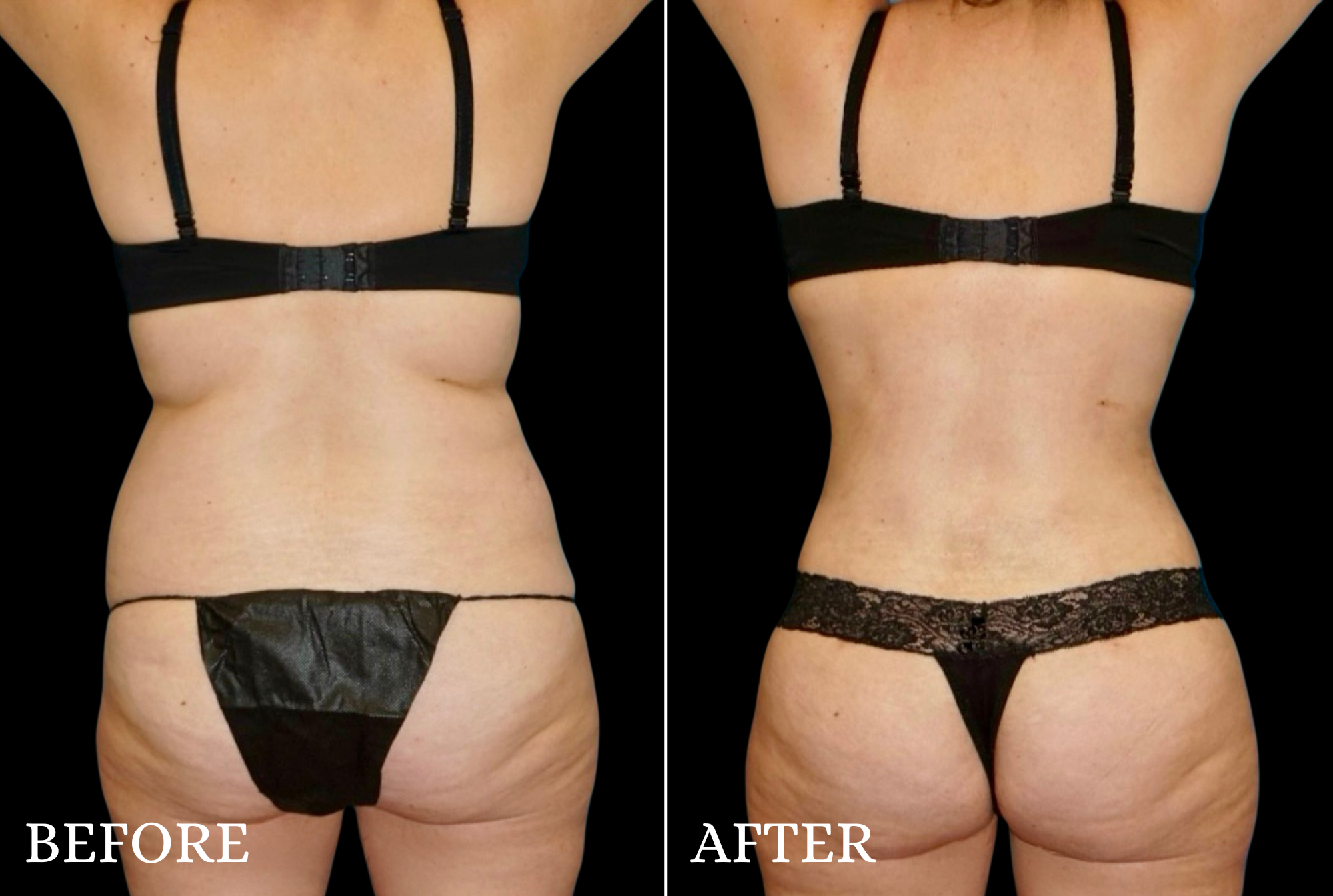 Tummy Tuck Before & After Gallery - Patient 132664 - Image 5