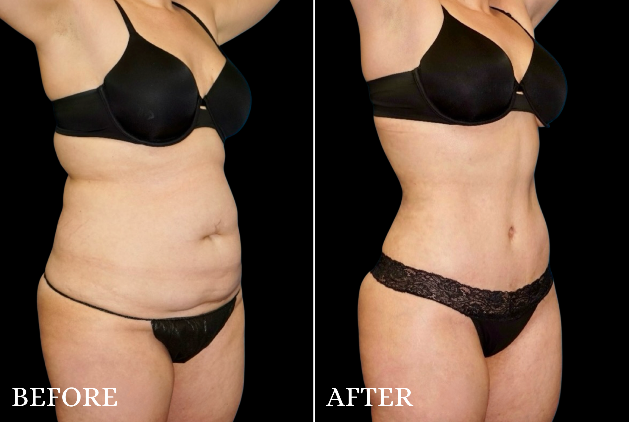 Tummy Tuck Before & After Gallery - Patient 132664 - Image 2