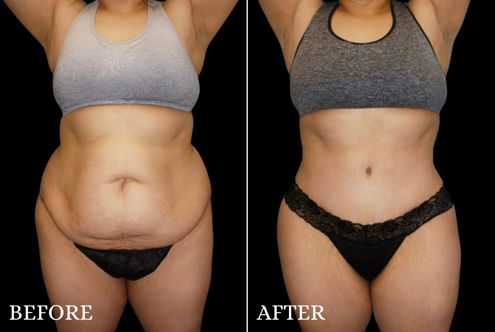 Tummy Tuck Before & After Gallery - Patient 428333 - Image 1