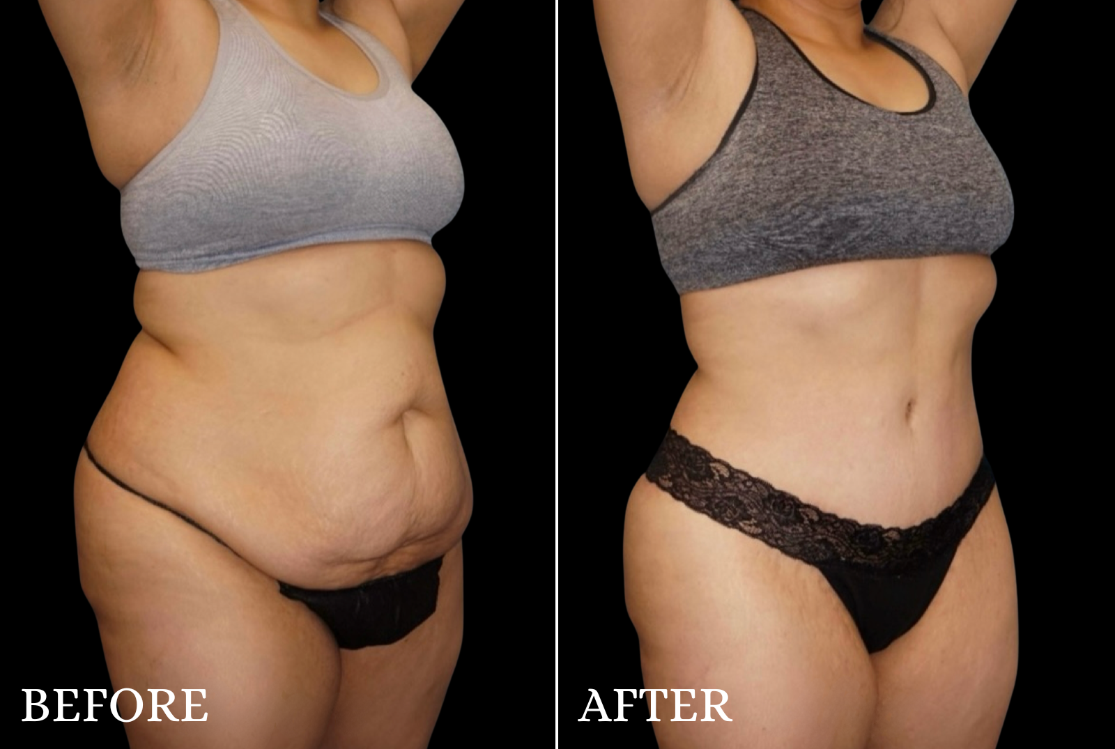 Tummy Tuck Before & After Gallery - Patient 428333 - Image 2