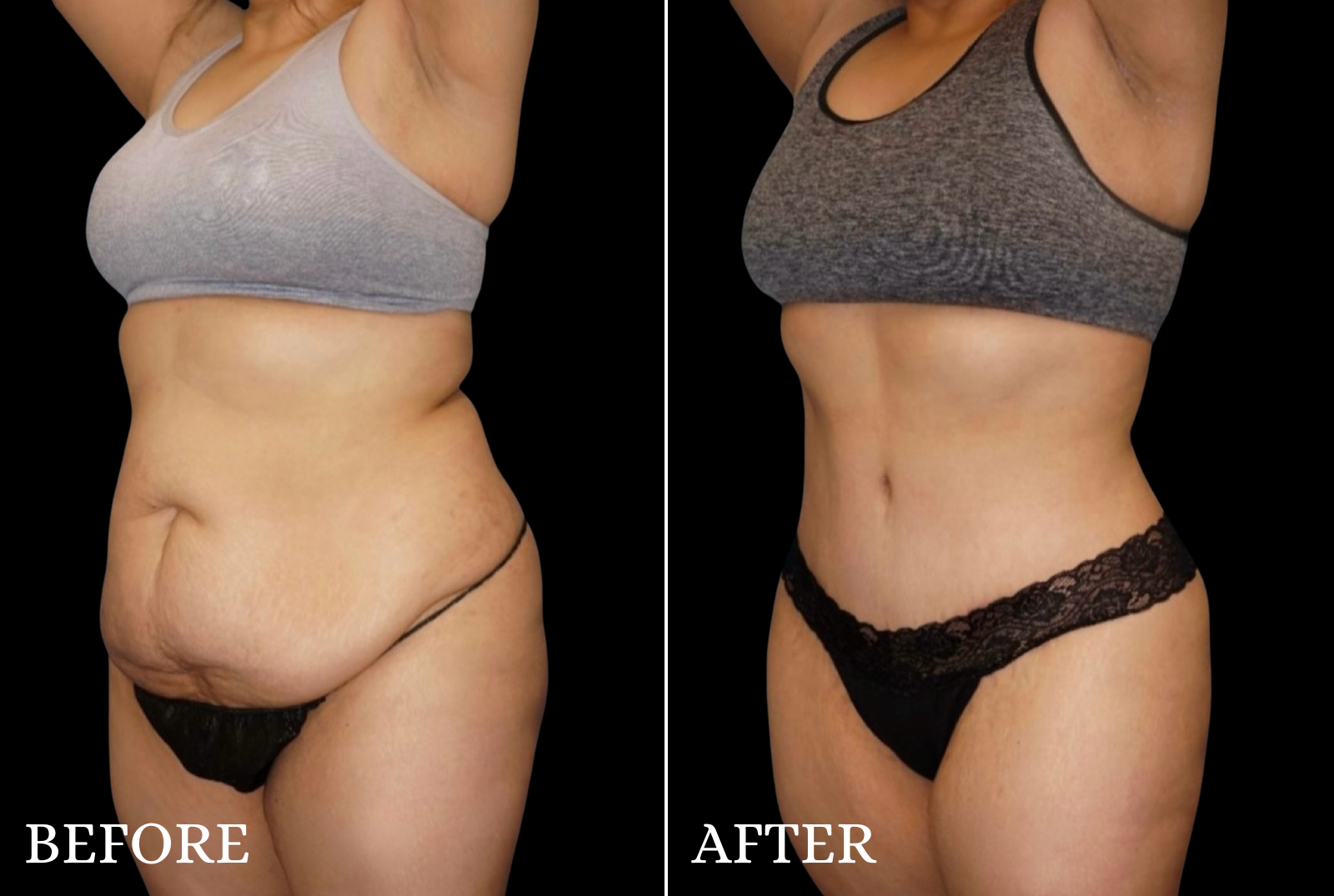Tummy Tuck Before & After Gallery - Patient 428333 - Image 4