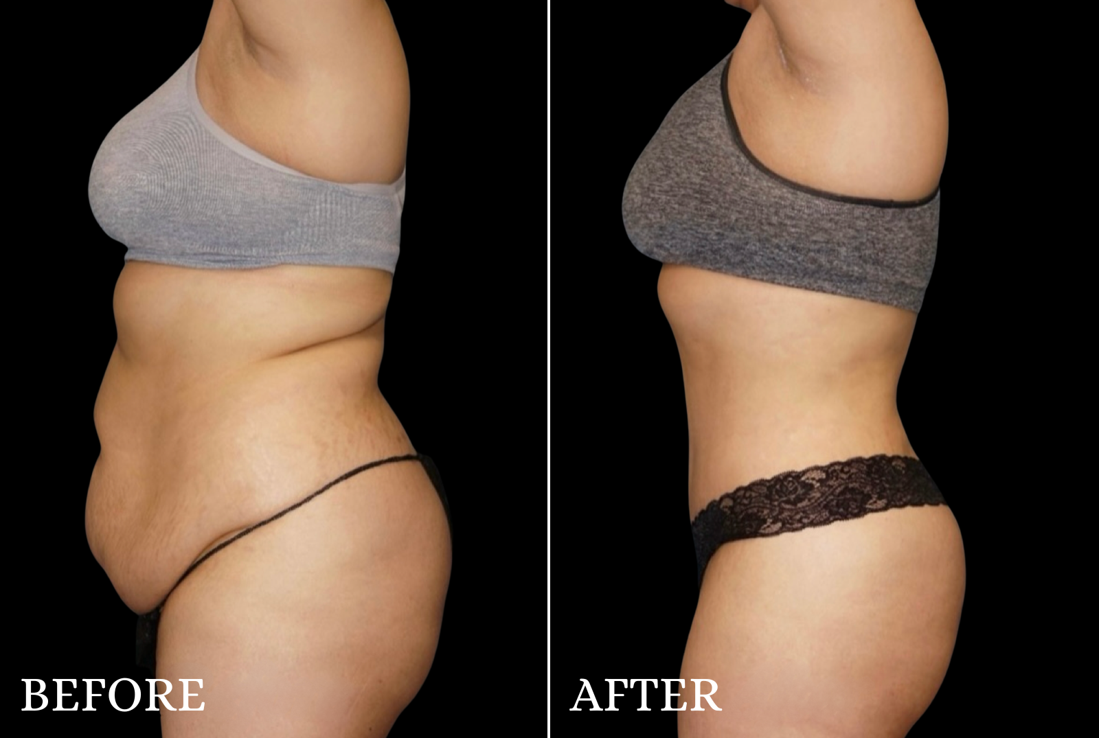 Tummy Tuck Before & After Gallery - Patient 428333 - Image 5