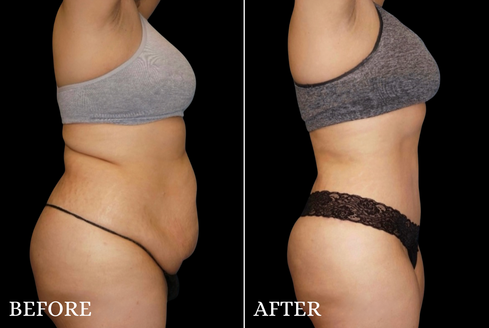 Tummy Tuck Before & After Gallery - Patient 428333 - Image 3