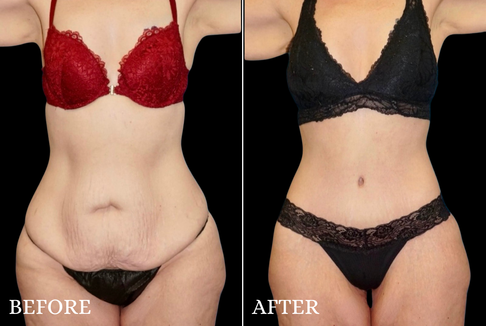 Tummy Tuck Before & After Gallery - Patient 306023 - Image 1