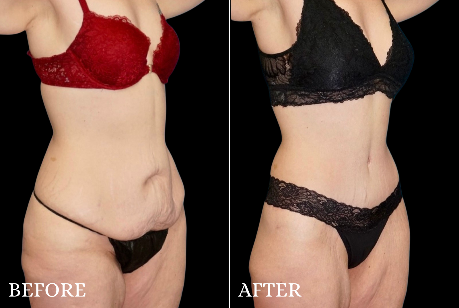 Tummy Tuck Before & After Gallery - Patient 306023 - Image 2