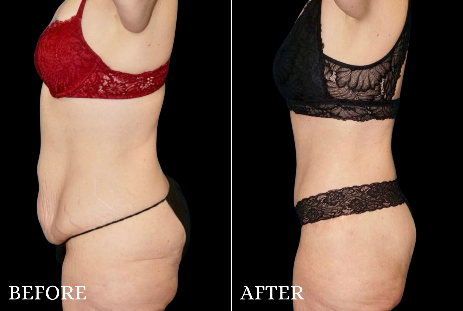 Tummy Tuck Before & After Gallery - Patient 306023 - Image 4
