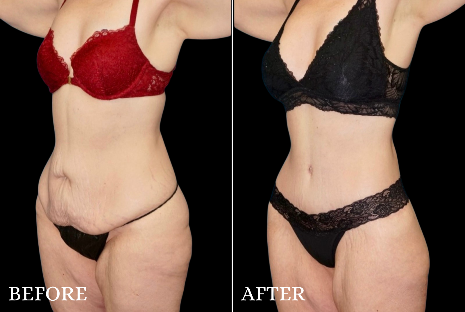 Tummy Tuck Before & After Gallery - Patient 306023 - Image 3