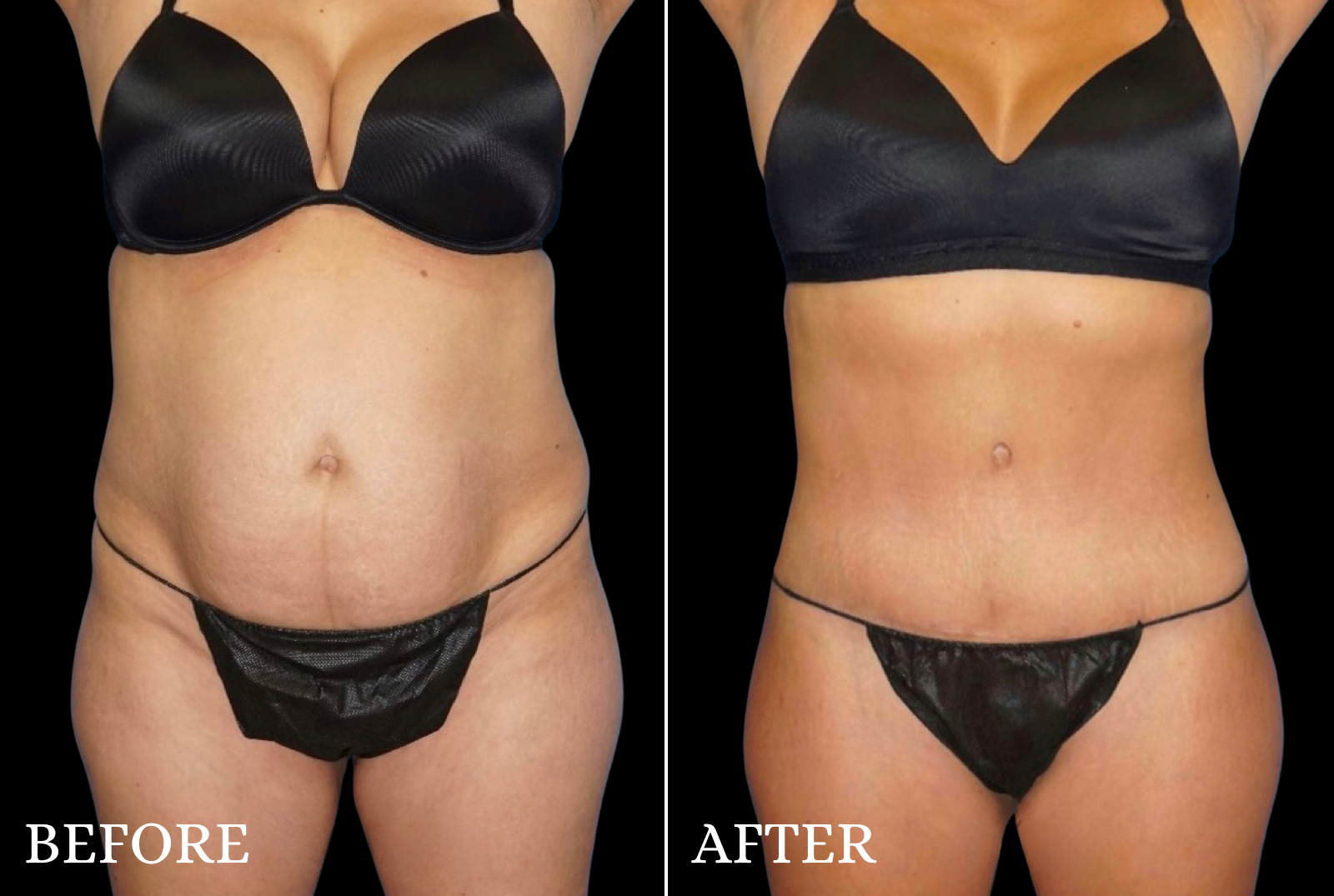 Tummy Tuck Before & After Gallery - Patient 141488 - Image 1