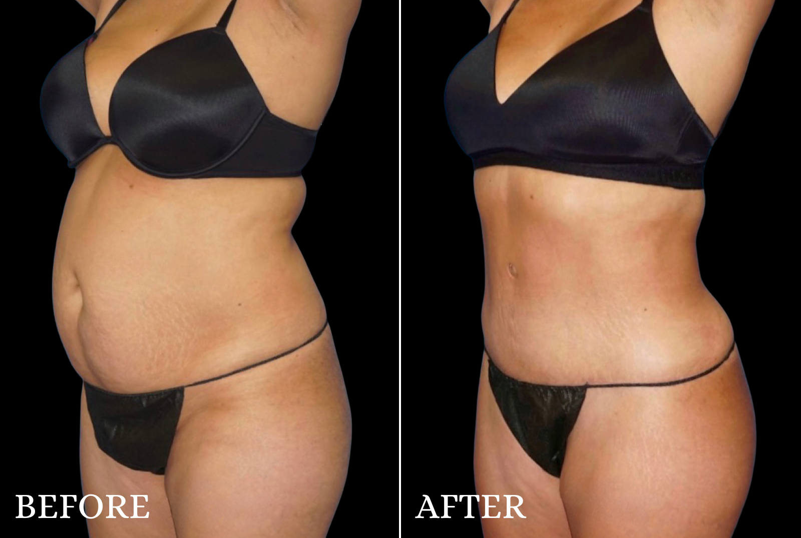 Tummy Tuck Before & After Gallery - Patient 141488 - Image 2