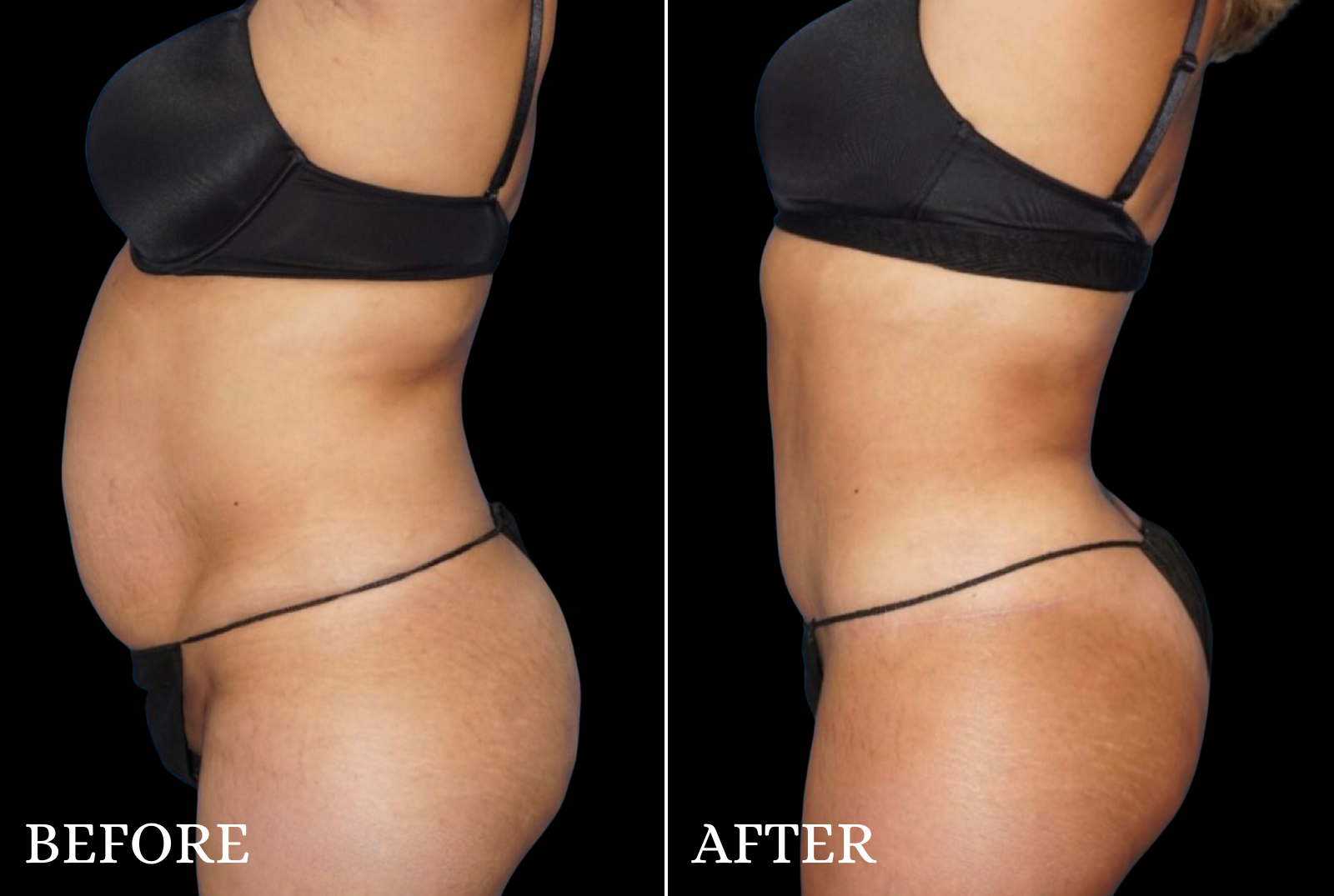 Tummy Tuck Before & After Gallery - Patient 141488 - Image 3