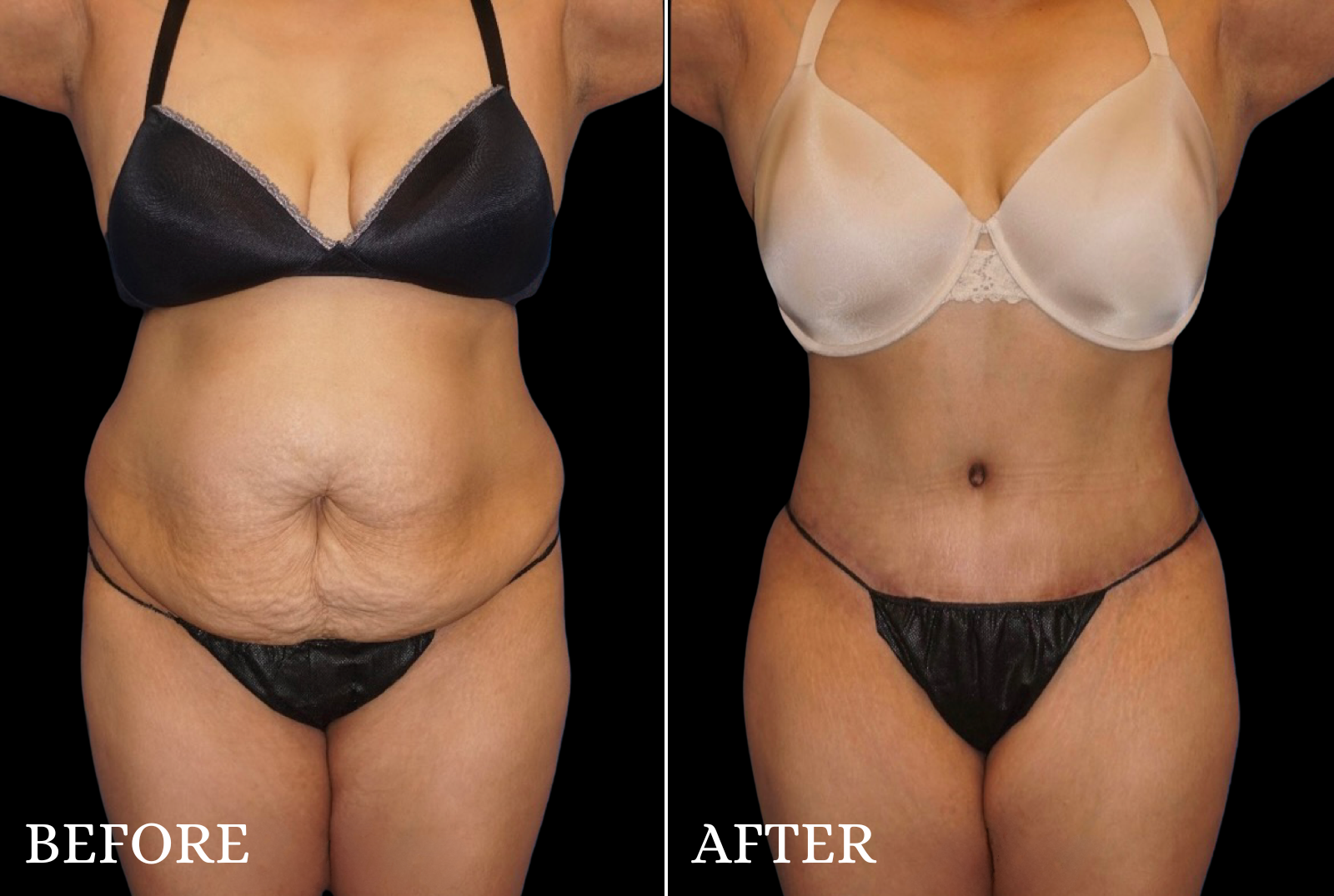 Tummy Tuck Before & After Gallery - Patient 806726 - Image 1