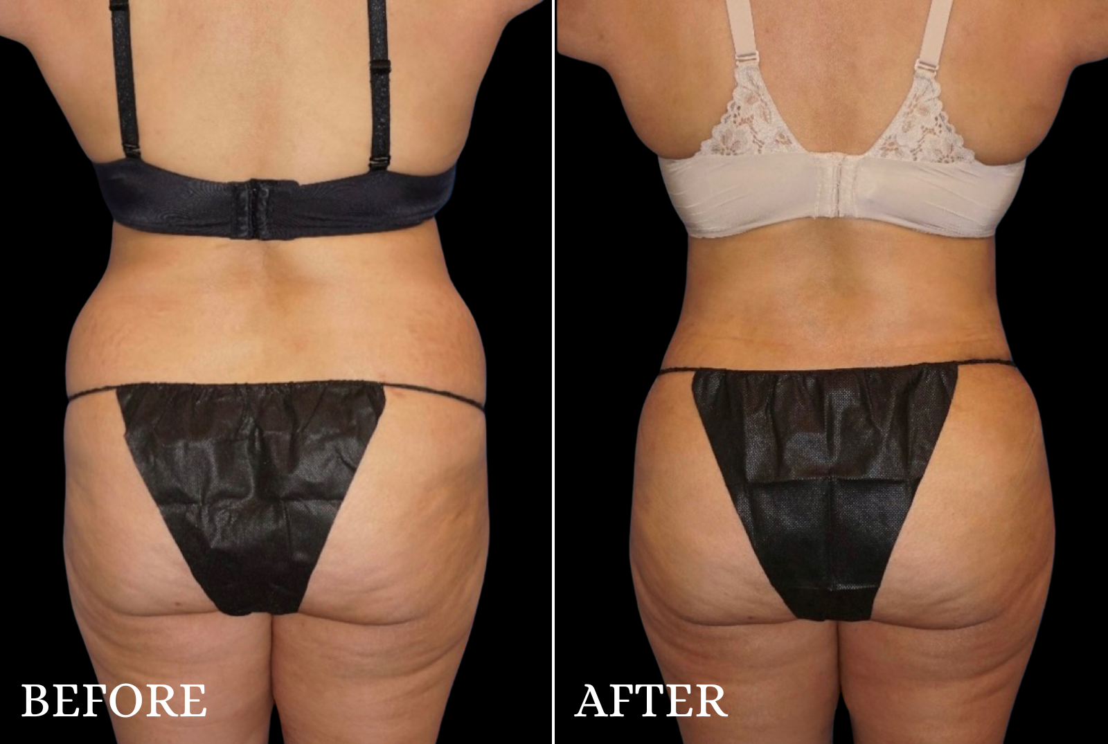 Tummy Tuck Before & After Gallery - Patient 806726 - Image 4