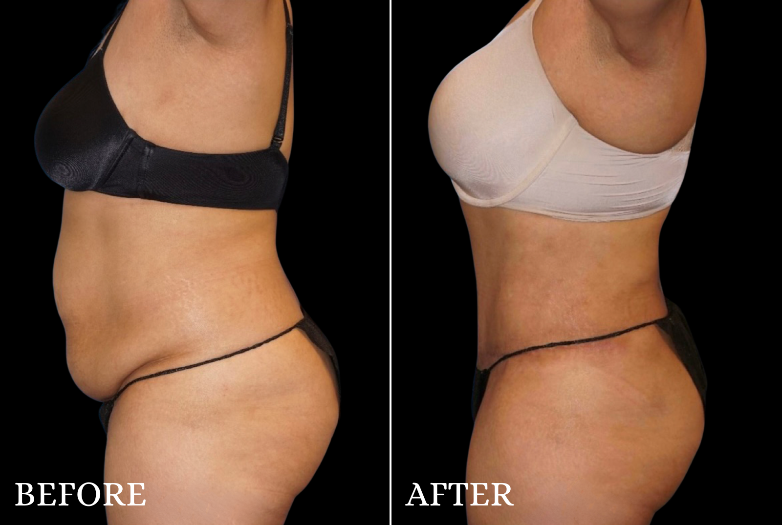 Tummy Tuck Before & After Gallery - Patient 806726 - Image 3
