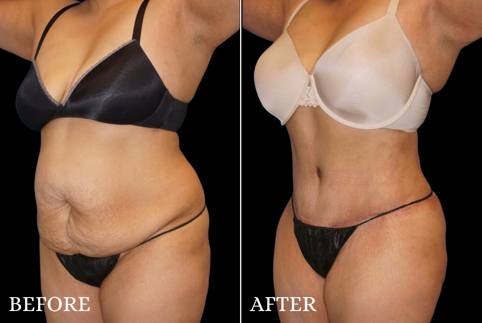 Tummy Tuck Before & After Gallery - Patient 806726 - Image 2