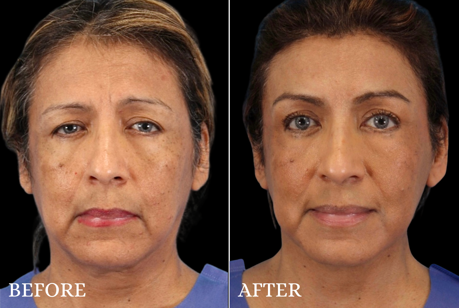 Upper Blepharoplasty Before & After Gallery - Patient 413112 - Image 1