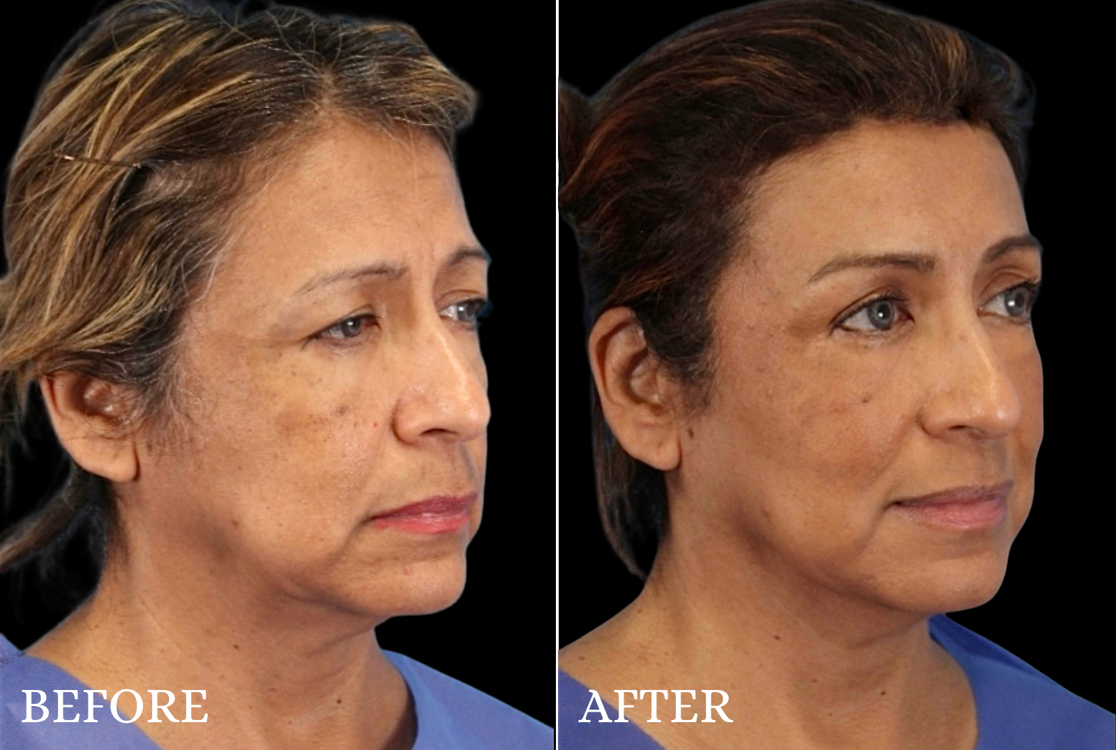 Upper Blepharoplasty Before & After Gallery - Patient 413112 - Image 5